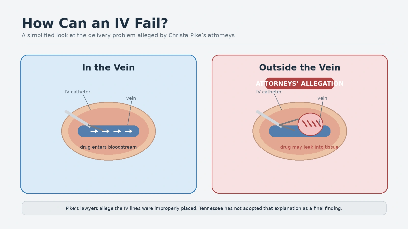 Medical explainer comparing an IV correctly placed in a vein with a suspected IV infiltration into surrounding tissue